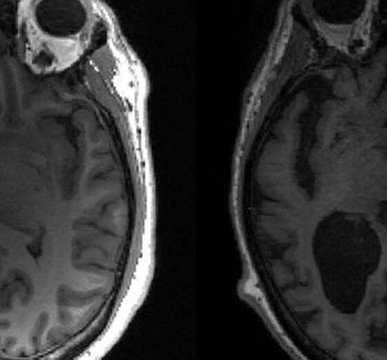 A descoberta que pode mudar o rumo dos tratamentos do Alzheimer; entenda